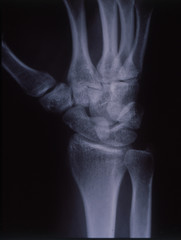 Röntgenbild der Hand