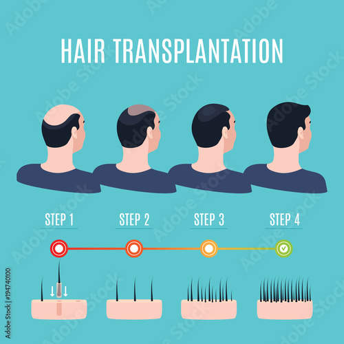 Hair Transplantation Surgery Steps Infographics Patient Before And