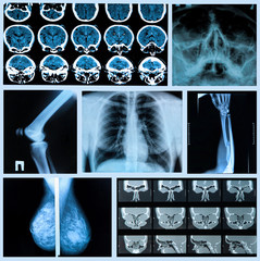 Radiography of Human Bones