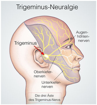 Trigeminusäste.Trigeminus-Neuralgie