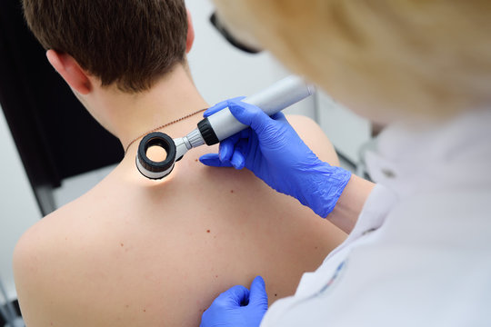 Method Of Dermatoscopy Of Skin Lesions And Moles. Preventing Melanoma And Skin Cancer