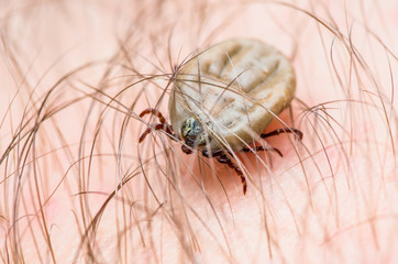 Encephalitis Virus or Lyme Disease or Monkey Fever Infected Tick Arachnid Insect on Skin