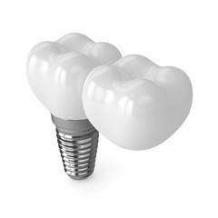 3d render of implant with dental cantilever bridge