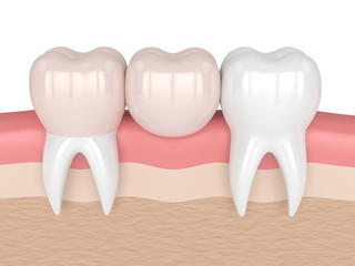 3d render of teeth with dental cantilever bridge