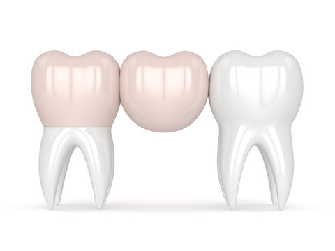 3d Render Of Teeth With Dental Cantilever Bridge