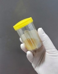 Closeup female hand in white disposable latex glove which holding the urine/body fluid specimen...