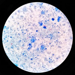 Smear of positive Acid-Fast bacilli (AFB) bacteria stained under 100X light microscope.