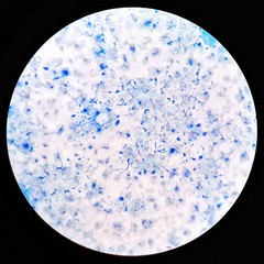 Smear of positive Acid-Fast bacilli (AFB) bacteria stained under 100X light microscope.