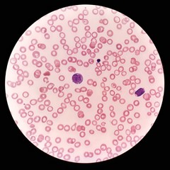 Human blood smear under 100X light microscope with blast cells, nucleated red blood cell (NRBC) and...