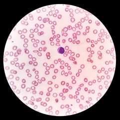Human blood smear under 100X light microscope with a blast cell and hypochromic red blood cells...