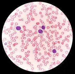 Human blood smear under 100X light microscope with blast cells and abnormal red blood cells...
