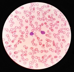 Human blood smear under 100X light microscope with blast cells and hypochromic red blood cells (Selective focus).