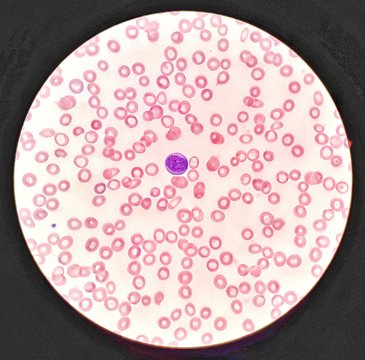 Human blood smear under 100X light microscope with blast cell and hypochromic red blood cells (Selective focus).