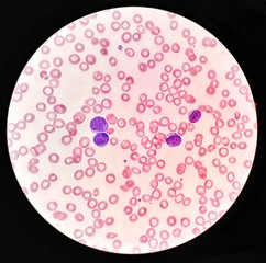 Human blood smear under 100X light microscope with blast cells and normal red blood cells...