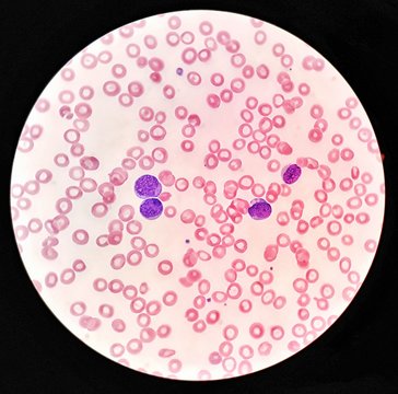 Human blood smear under 100X light microscope with blast cells and normal red blood cells (Selective focus).
