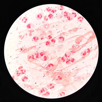 Smear of Gram's stained from sputum specimen with gram positive cocci bacteria, mucous and numerous white blood cells, under 100X light microscope .