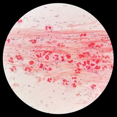 Smear of Gram's stained from sputum specimen with gram positive cocci bacteria, mucous and numerous...