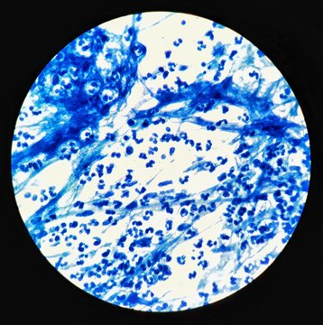 Smear of Acid-Fast bacilli (AFB) stained from sputum specimen with mucous and numerous white blood cells, under 100X light microscope .