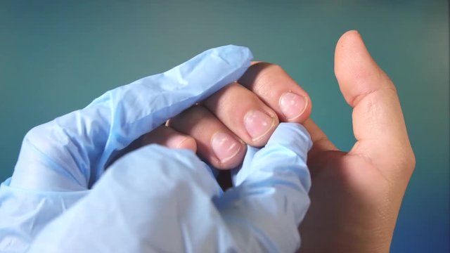 white spots on the nails of a man's hands