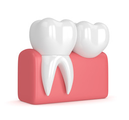 3d render of teeth with dental cantilever bridge