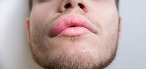 Obraz premium allergy on the lip. Angioedema.