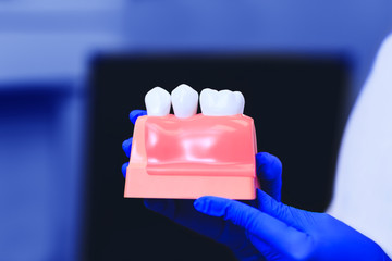 Model of teeth with dental implant in the hands of real doctor, closeup. Tooth restoration. Installation of the dental implant. Dental prostheses. Artificial teeth with steel pin. Care and dentistry.