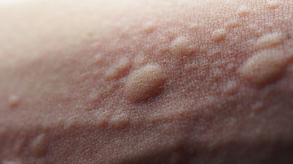 Macro image of symptoms of itchy urticaria or rash