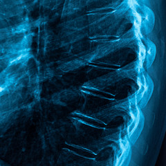 x-ray of backbone