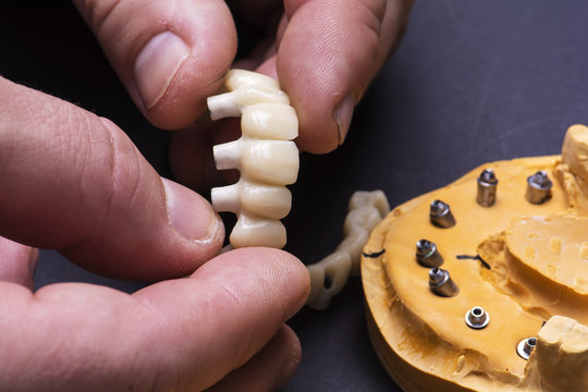 Creating temporary crowns on implants