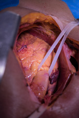 Doctors team wear blue coat perform heart surgery at the operating room in the hospital.