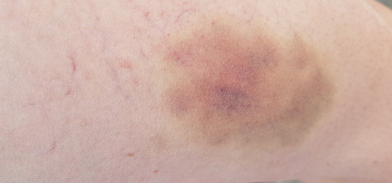 h&eacute;mat&ocirc;me sur la peau,contusion