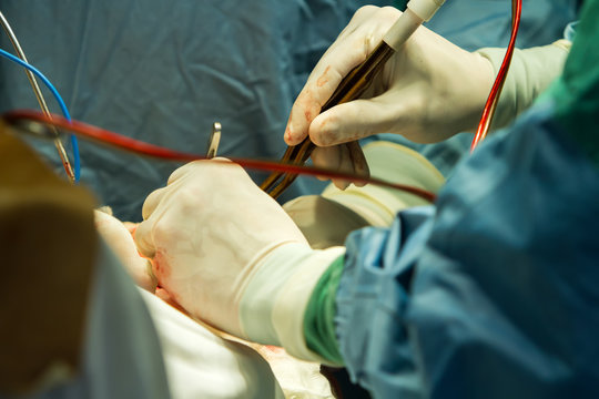 Operation of trepanation of the skull.