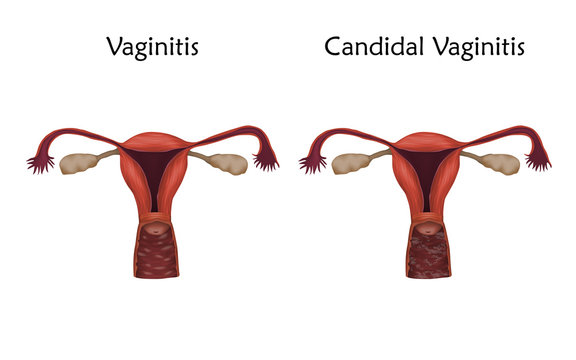 Vaginitis and candidal vaginitis. Human realistic uterus. Anatomy illustration. Colored image, white background. Gynecological diseases.