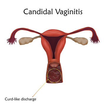 Candidal Vaginitis. Human realistic uterus. Anatomy illustration with specification. Colored image, white background. Gynecological diseases.