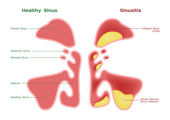 nasal sinus. Healthy and inflammation sinus vector