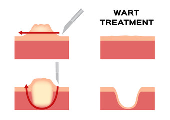 wart treatment . remove it from skin by surgery vector callus - obrazy, fototapety, plakaty