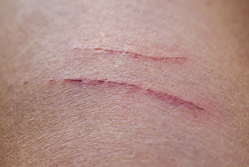  two shallow aching sore inflamed scratches on human skin