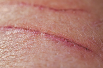 sore inflamed scratch on human skin