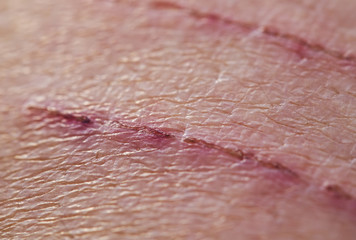 two aching sore wounds, inflamed scratches on the human skin