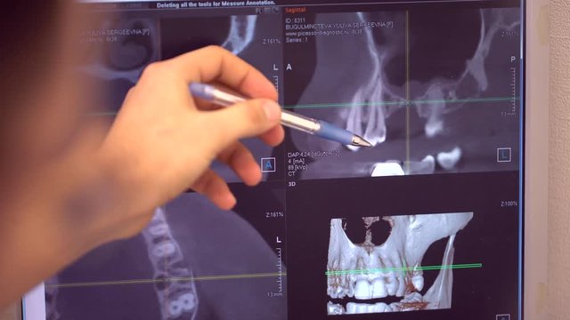 the dentist shows to the patient x-ray picture of his teeth on the computer 4 k