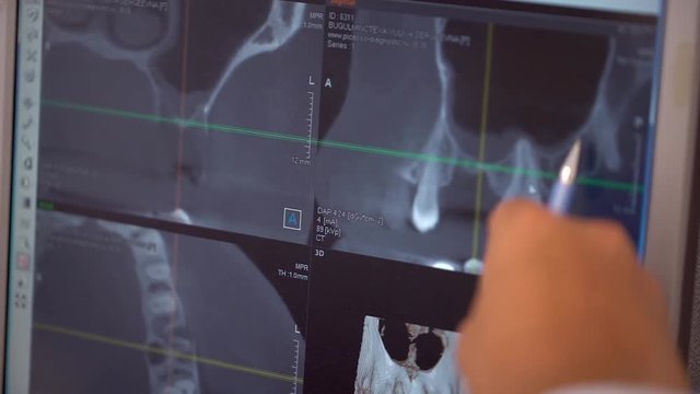 dental assistent discussing with dentist about the tooth's problem on x-ray shot. slow-motion. close-up. Dental X ray with bad teeth. slow-motion. dentist examining x-ray report on computer in clinic