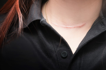 Scars on woman's neck from thyroid surgery