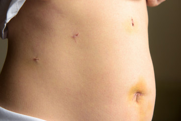 Woman's belly with medical stitches after surgery by laparoscopy