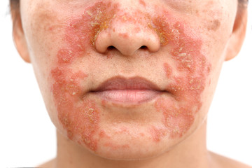 Seborrheic Dermatitis face - obrazy, fototapety, plakaty