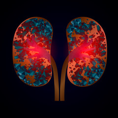  Nephrolithiasis kidney stones disease. Vector medical illustration isolated