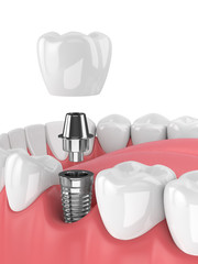 3d render of jaw with teeth and dental molar implant © Aleksandra Gigowska