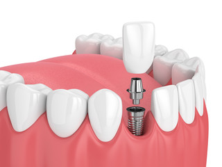 3d render of jaw with teeth and dental incisor implant - obrazy, fototapety, plakaty