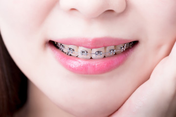 close up woman wear brace