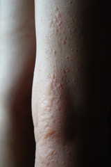 Fototapeta premium urticaria on woman's legs