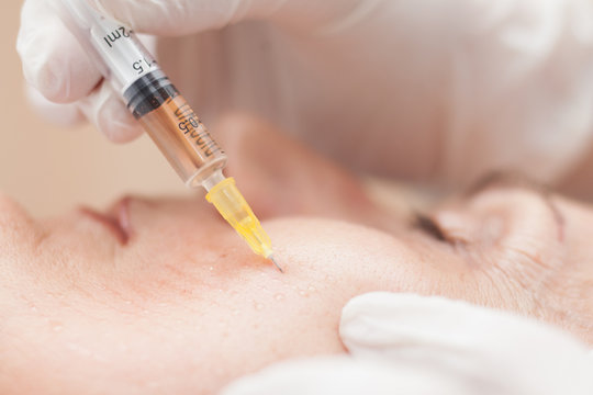 close up of woman having mesotherapy treatment